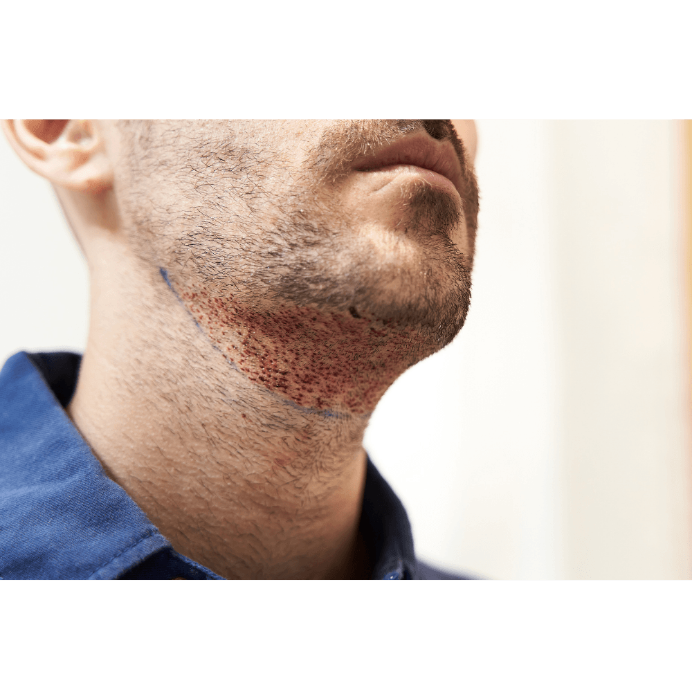Beard Transplant