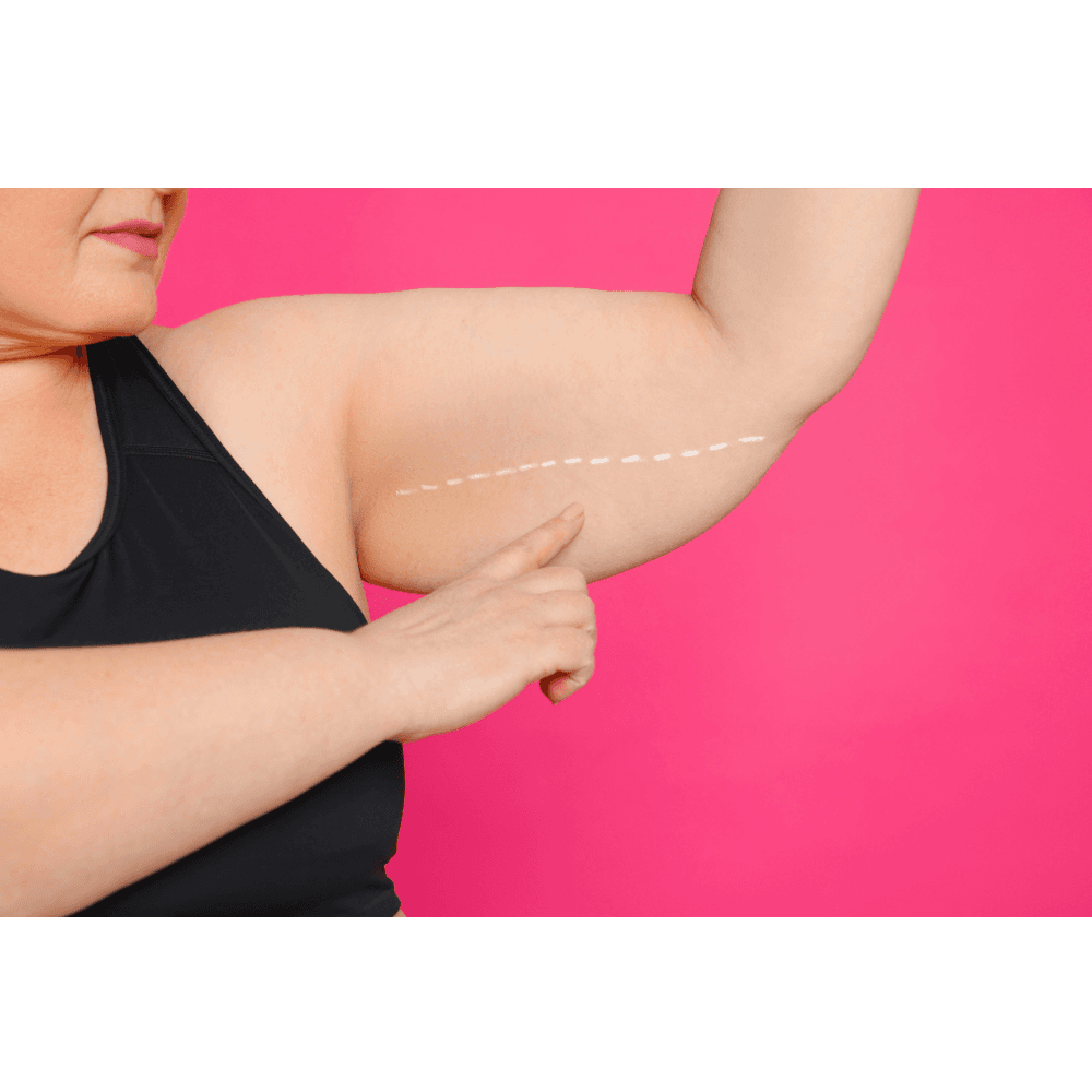 Arm Lift