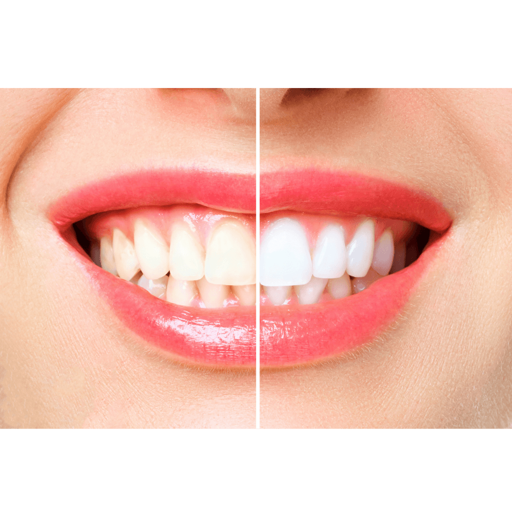 Teeth Whitening